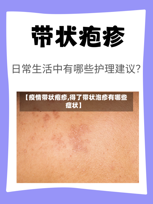 【疫情带状疱疹,得了带状泡疹有哪些症状】
