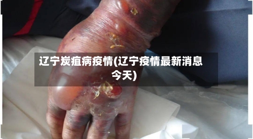 辽宁炭疽病疫情(辽宁疫情最新消息今天)-第3张图片